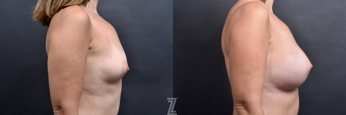 After: Breast Augmentation — Case 528, The Piazza Center Austin