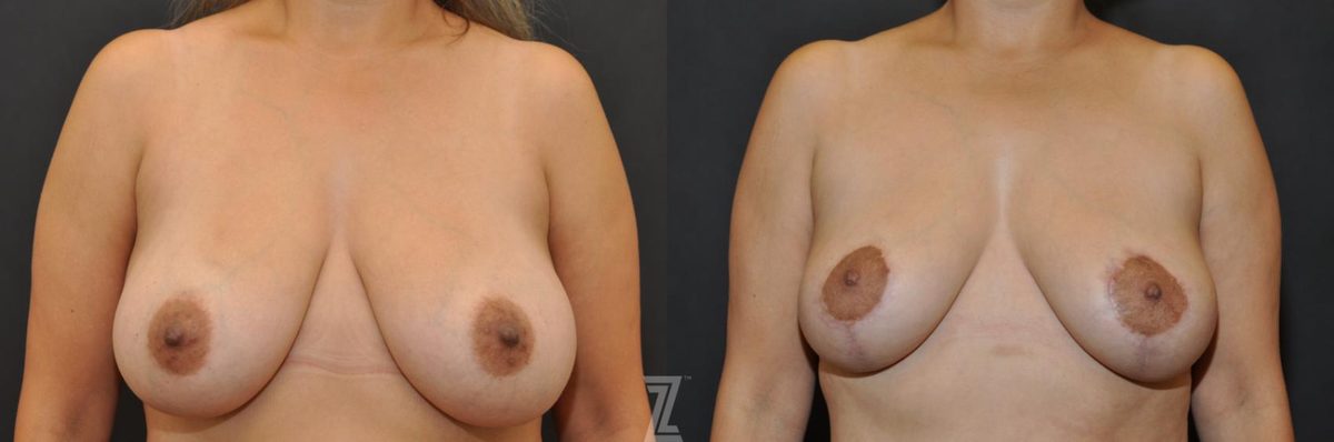 Before: Breast Reduction, Breast Lift — Case 506, The Piazza Center Austin