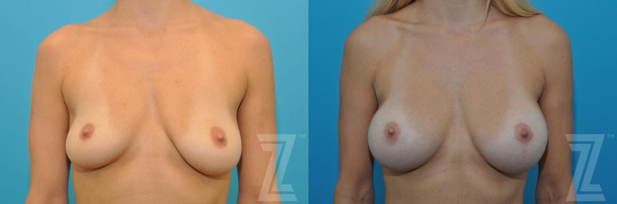 Before: Correction of Breast Asymmetry, Breast Augmentation with a Breast Lift — Case 71, The Piazza Center Austin