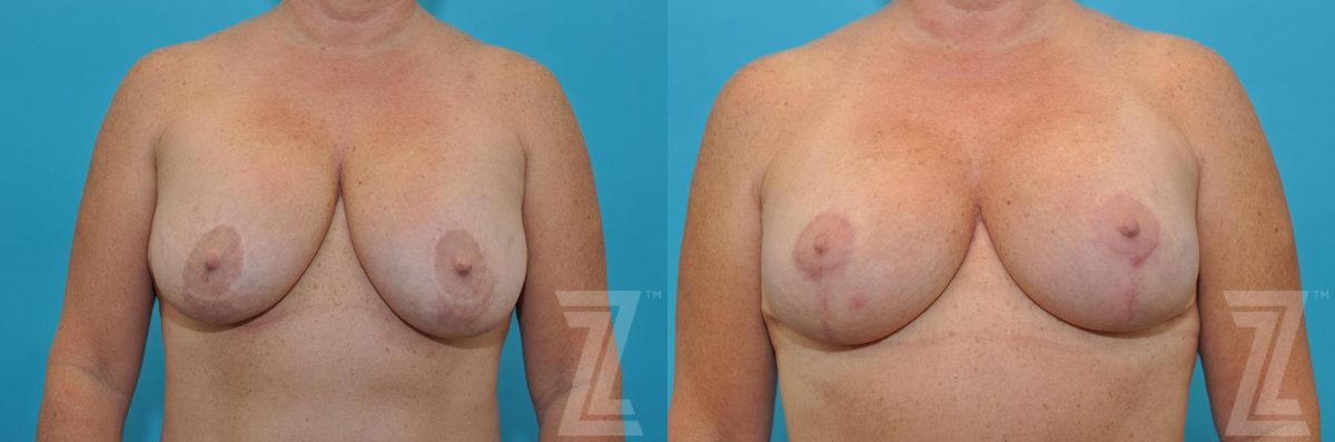 Before: Breast Augmentation Revision — Case 247, The Piazza Center Austin