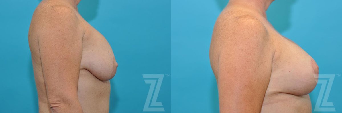 After: Breast Augmentation Revision — Case 247, The Piazza Center Austin