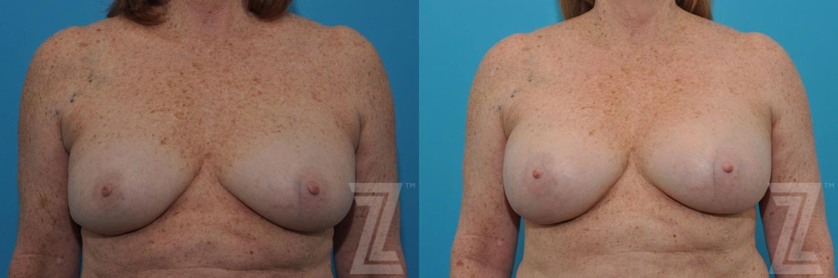 Before: Breast Augmentation Revision — Case 34, The Piazza Center Austin