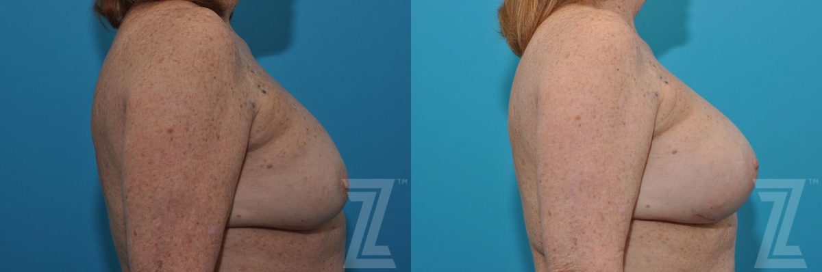 After: Breast Augmentation Revision — Case 34, The Piazza Center Austin