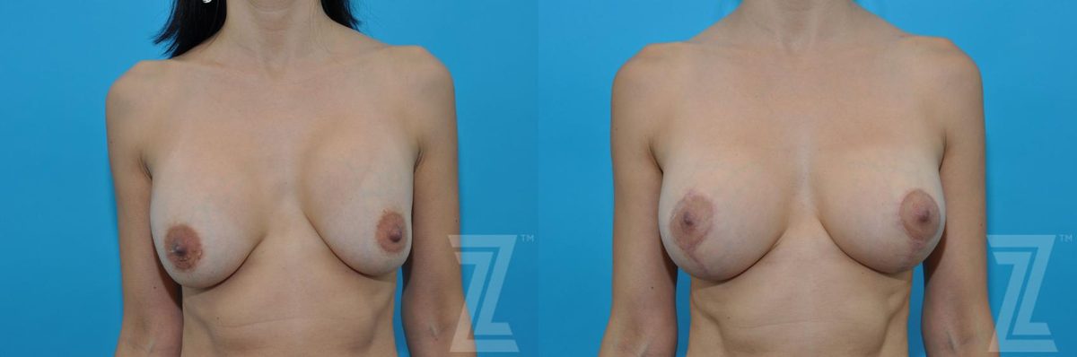 Before: Breast Augmentation Revision — Case 133, The Piazza Center Austin