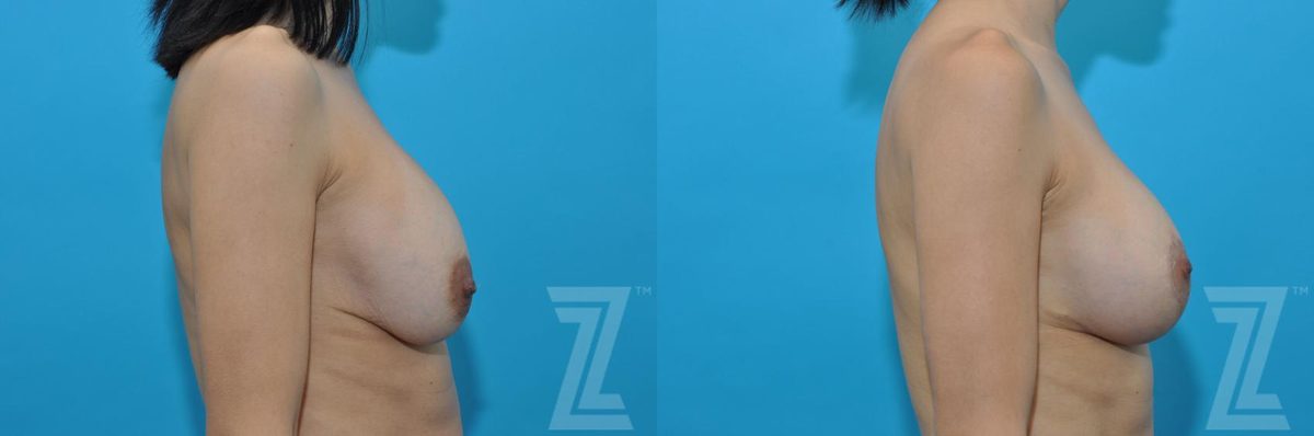 After: Breast Augmentation Revision — Case 133, The Piazza Center Austin