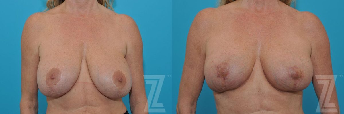 Before: Breast Augmentation Revision — Case 77, The Piazza Center Austin