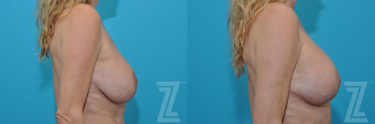 After: Breast Augmentation Revision — Case 77, The Piazza Center Austin