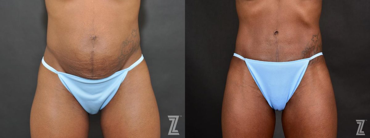 Before: The After Baby Body, Loose Tummy Skin, Tummy Tuck — Case 468, The Piazza Center Austin