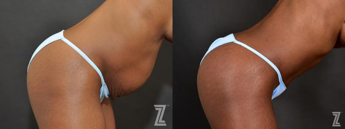After: The After Baby Body, Loose Tummy Skin, Tummy Tuck — Case 468, The Piazza Center Austin