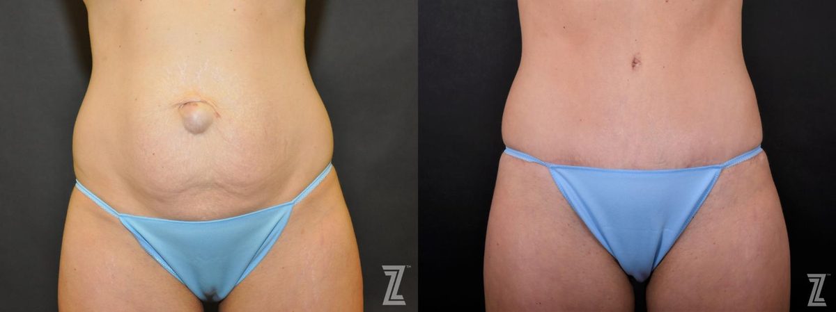 Before: The After Baby Body, Tummy Tuck — Case 467, The Piazza Center Austin
