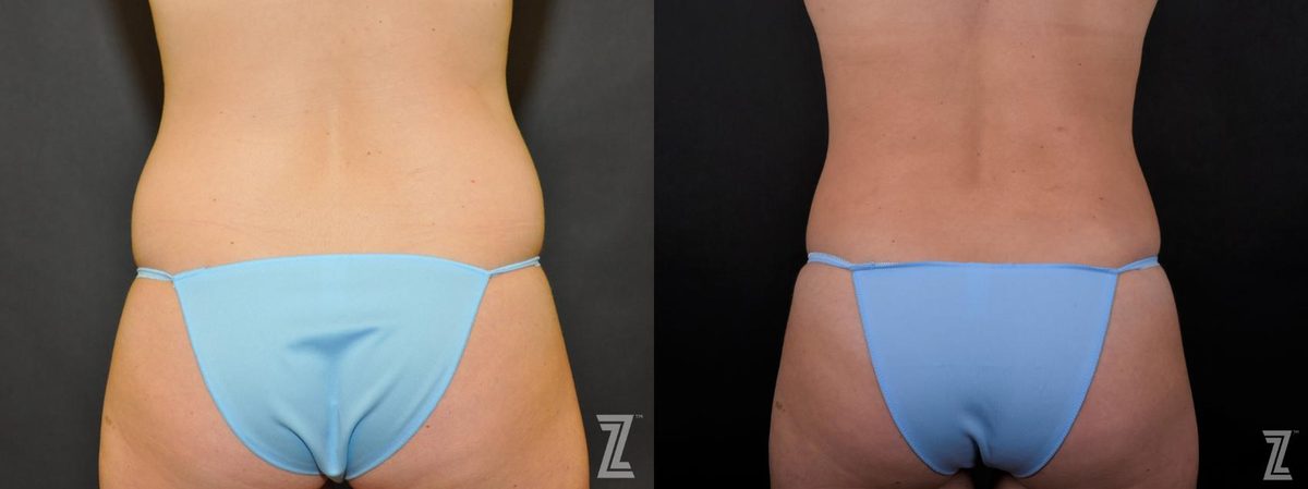 After: The After Baby Body, Tummy Tuck — Case 467, The Piazza Center Austin