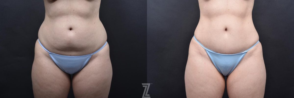 Before: Liposuction, Skin Pinch — Case 559, The Piazza Center Austin