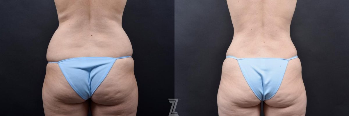 After: Liposuction, Skin Pinch — Case 559, The Piazza Center Austin