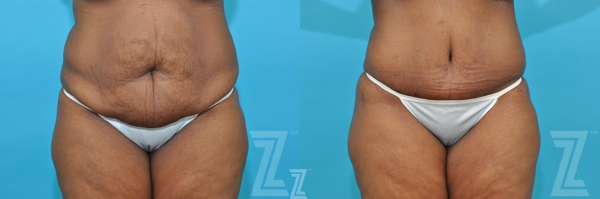 Before: Liposuction — Case 211, The Piazza Center Austin