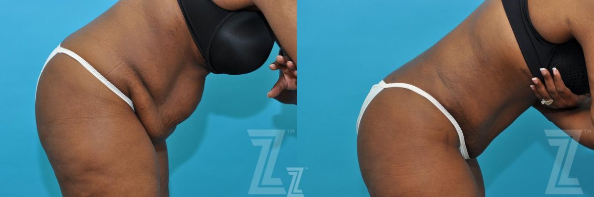 After: Liposuction — Case 211, The Piazza Center Austin