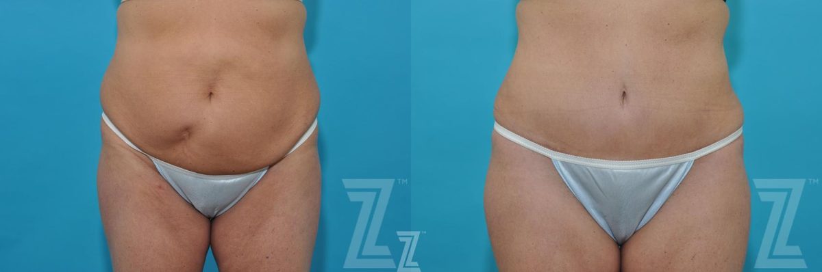 Before: Liposuction — Case 214, The Piazza Center Austin