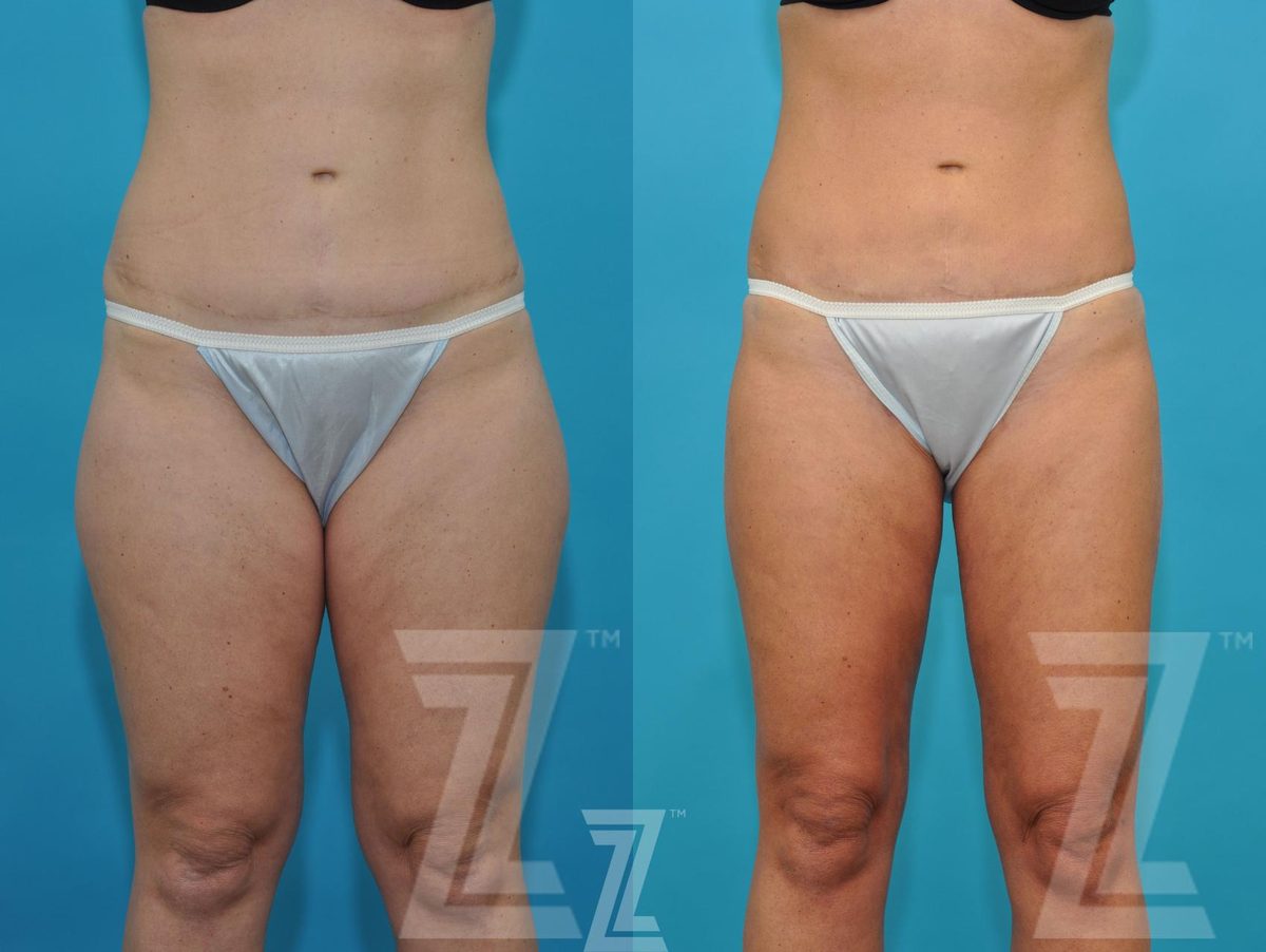 Before: Liposuction — Case 184, The Piazza Center Austin