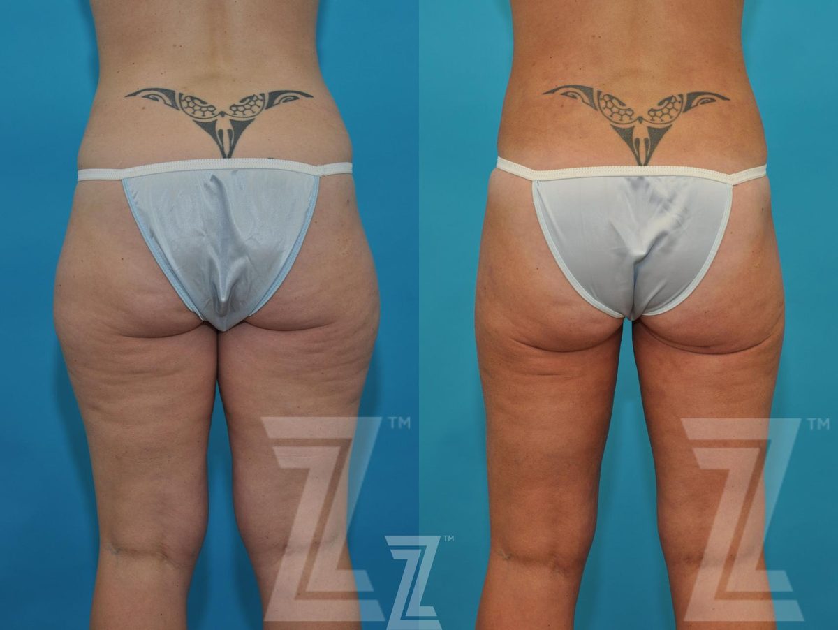After: Liposuction — Case 184, The Piazza Center Austin