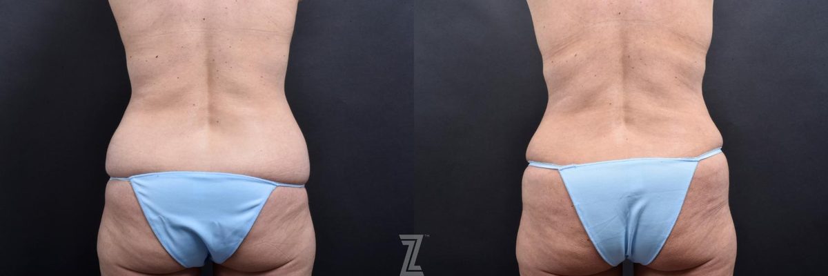 After: Breast Augmentation with a Breast Lift, Tummy Tuck, Mommy Makeover — Case 550, The Piazza Center Austin