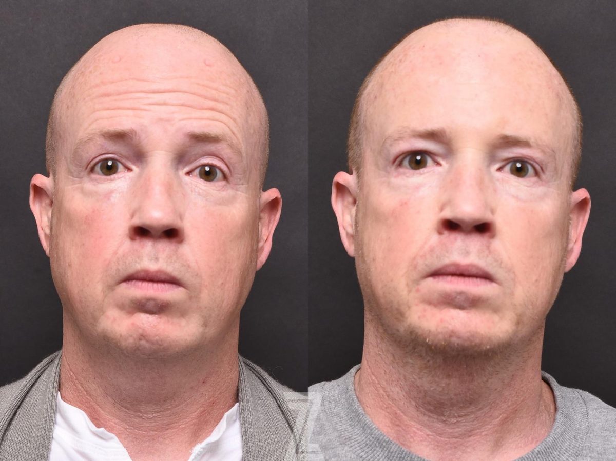 Before: BBL, BOTOX® Cosmetic — Case 505, The Piazza Center Austin