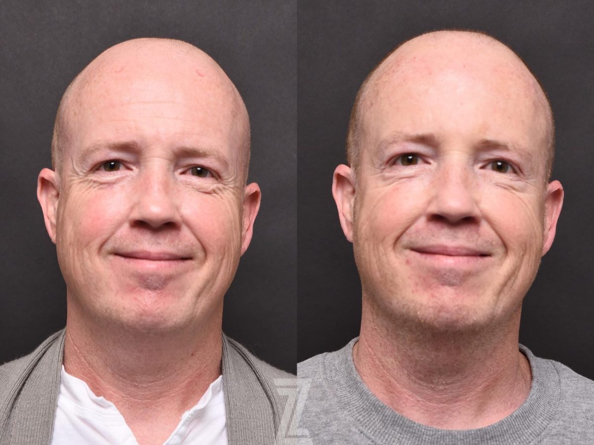 After: BBL, BOTOX® Cosmetic — Case 505, The Piazza Center Austin