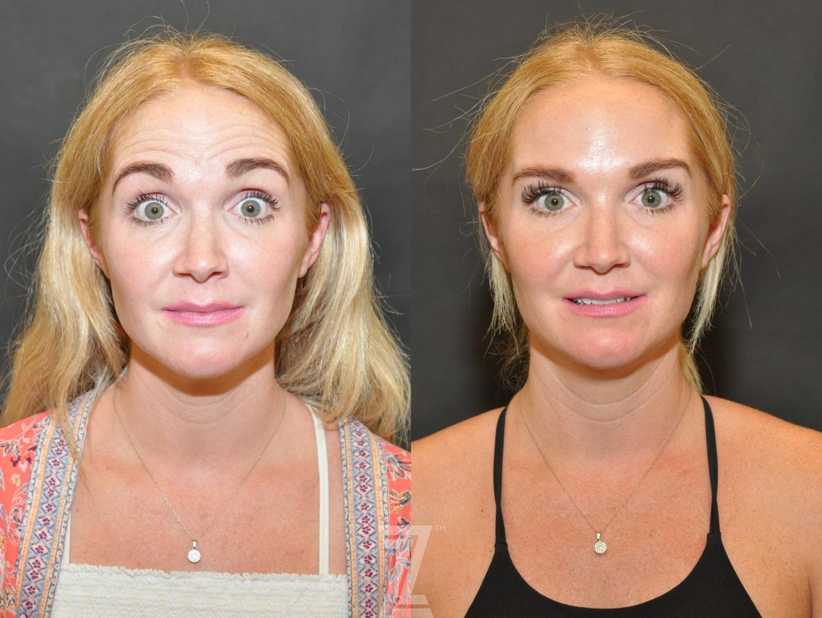 After: BOTOX® Cosmetic — Case 575, The Piazza Center Austin