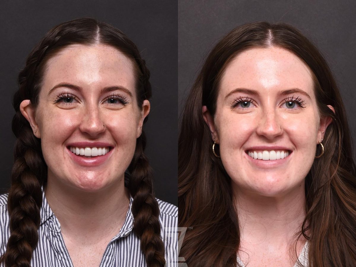 Before: Wrinkles, BOTOX® Cosmetic — Case 499, The Piazza Center Austin