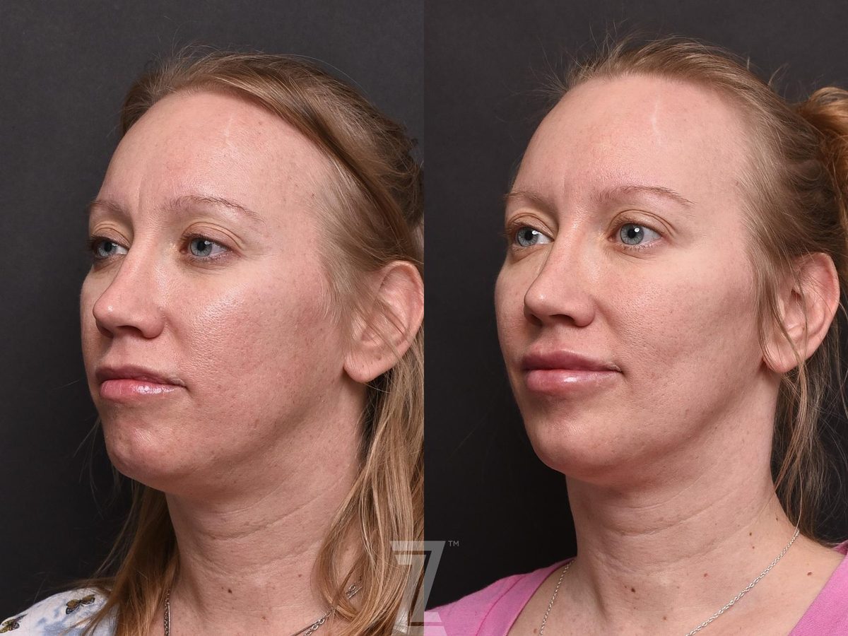 Before: BOTOX® Cosmetic, BBL, HALO, Hyperpigmentation, Aging Skin, Wrinkles, Sun Damage, Texture, Injectable Fillers — Case 503, The Piazza Center Austin