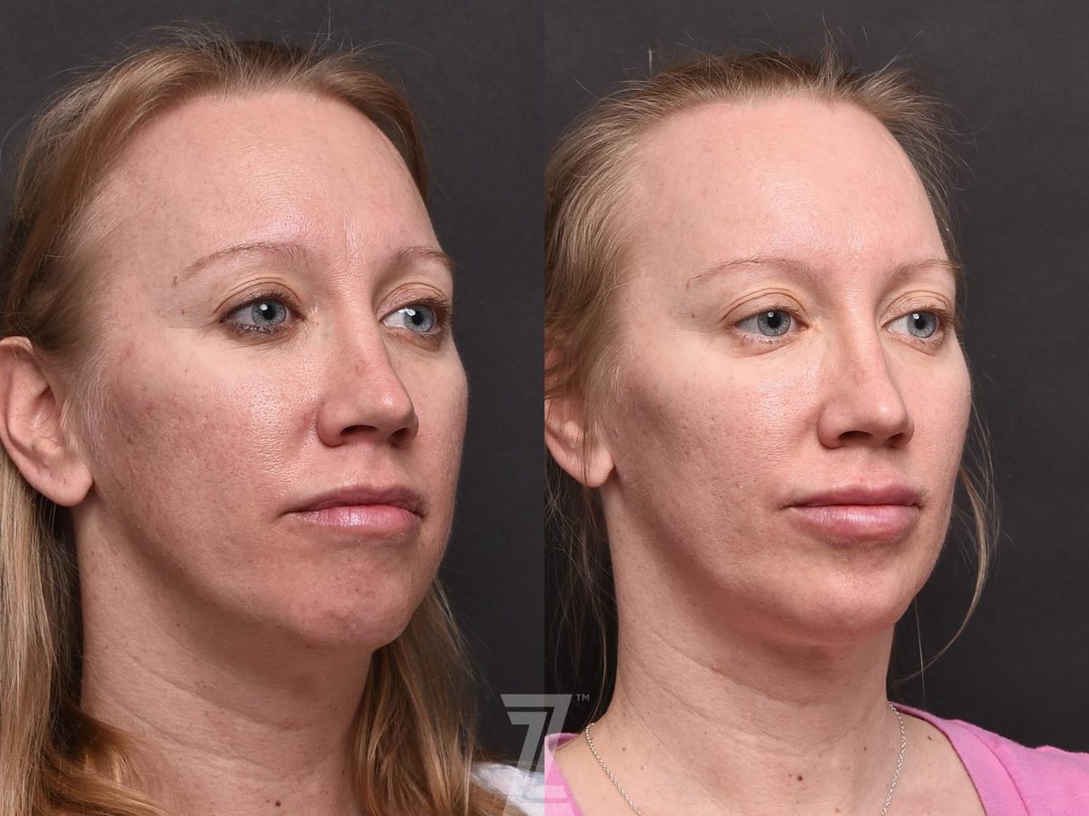 After: BOTOX® Cosmetic, BBL, HALO, Hyperpigmentation, Aging Skin, Wrinkles, Sun Damage, Texture, Injectable Fillers — Case 503, The Piazza Center Austin