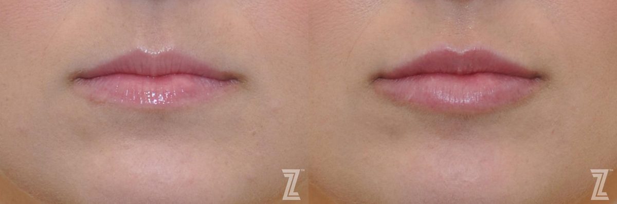 Before: Injectable Fillers — Case 280, The Piazza Center Austin