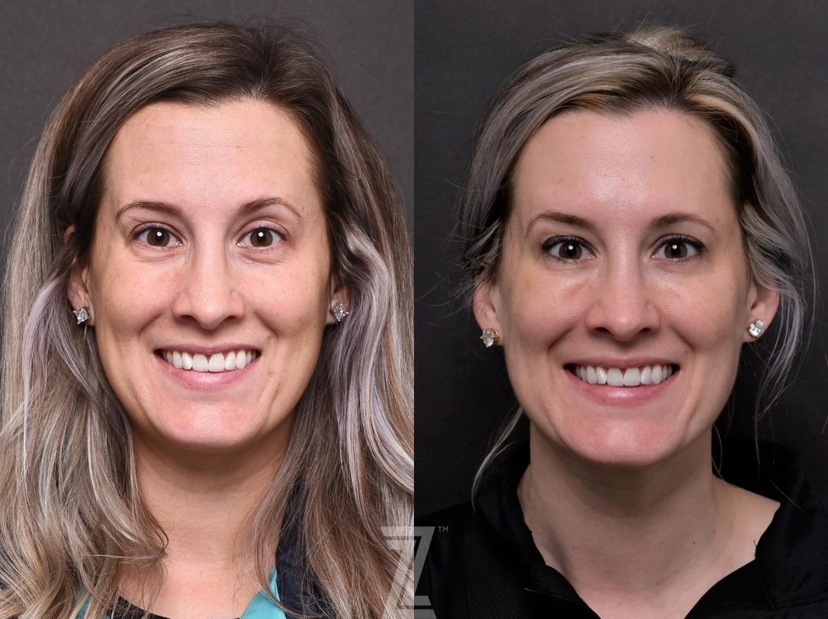 Before: Aging Skin, Wrinkles, Under Eye Bags and Dark Circles, Injectable Fillers — Case 553, The Piazza Center Austin
