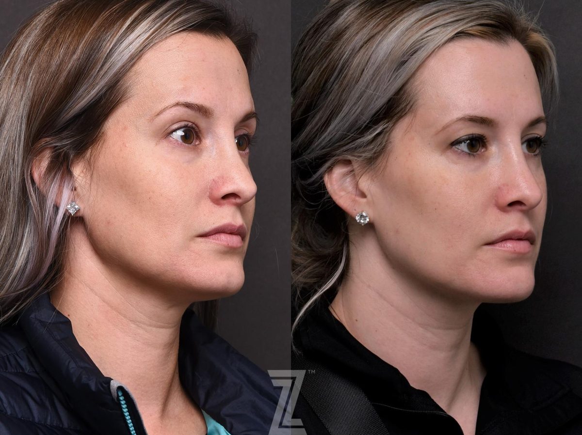 After: Aging Skin, Wrinkles, Under Eye Bags and Dark Circles, Injectable Fillers — Case 553, The Piazza Center Austin