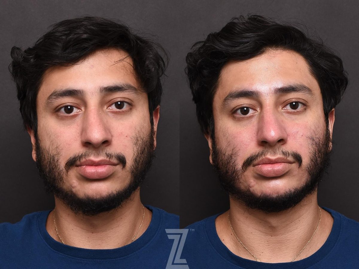 Before: Teen Acne, Adult Acne, Large Pores, Texture, HydraFacial™ — Case 504, The Piazza Center Austin