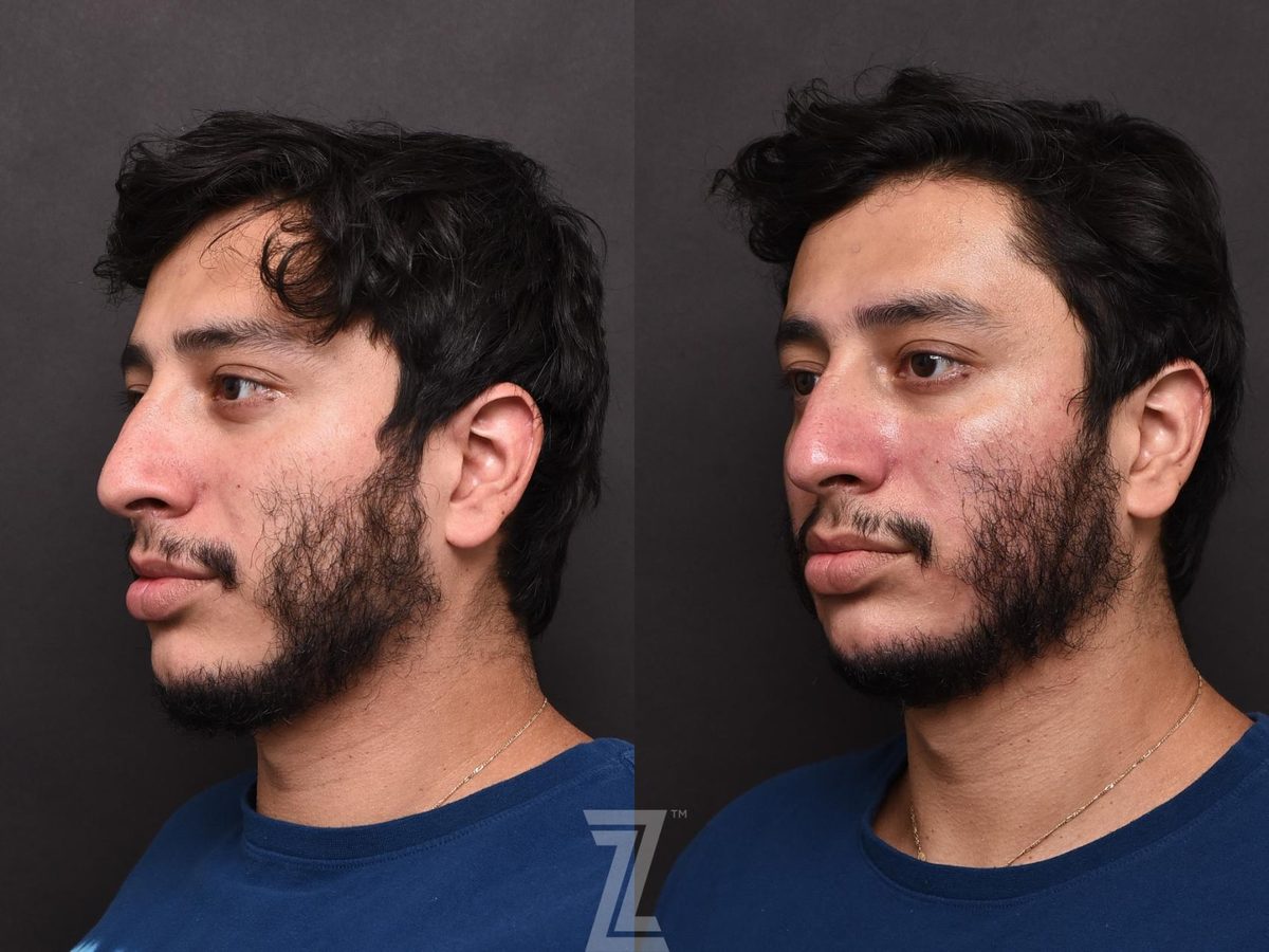 After: Teen Acne, Adult Acne, Large Pores, Texture, HydraFacial™ — Case 504, The Piazza Center Austin