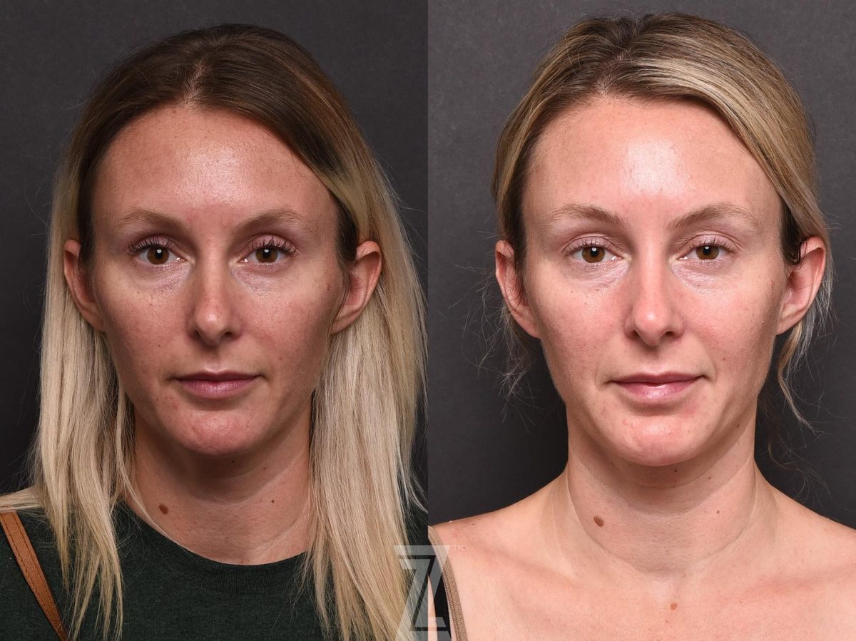 Before: Hyperpigmentation, Wrinkles, Sun Damage, BBL — Case 502, The Piazza Center Austin
