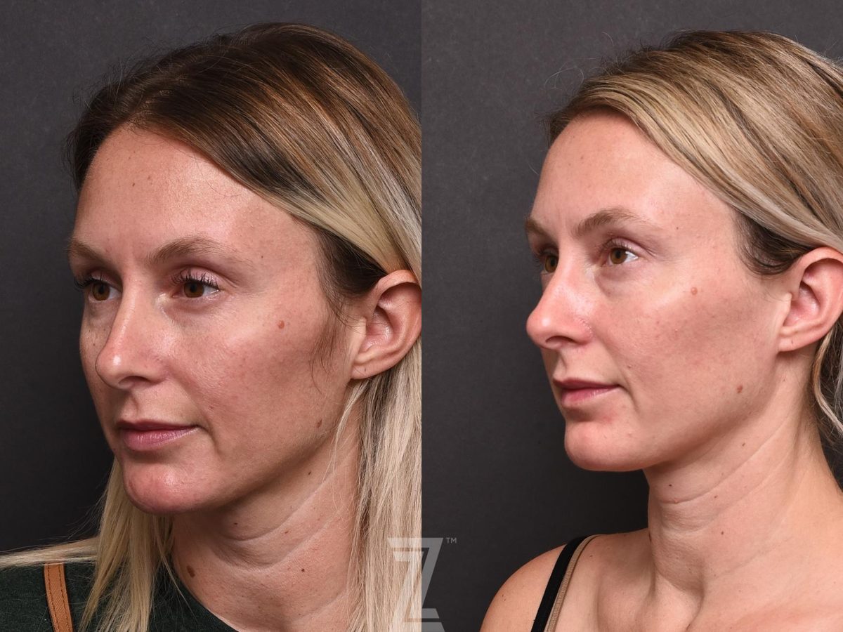 After: Hyperpigmentation, Wrinkles, Sun Damage, BBL — Case 502, The Piazza Center Austin