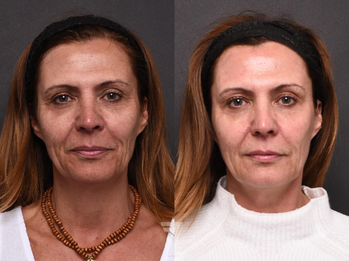 Before: Micropigmentation, BBL, Hyperpigmentation, Aging Skin, Wrinkles, Sun Damage, Texture, HALO — Case 501, The Piazza Center Austin
