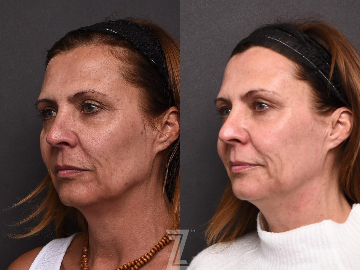 After: Micropigmentation, BBL, Hyperpigmentation, Aging Skin, Wrinkles, Sun Damage, Texture, HALO — Case 501, The Piazza Center Austin
