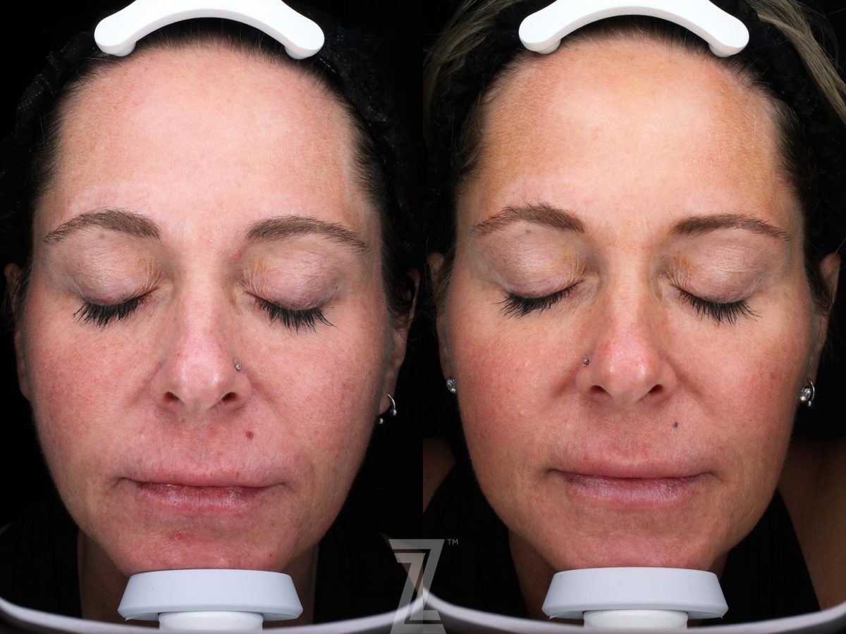 Before: BBL, Visia Skincare Analysis — Case 548, The Piazza Center Austin