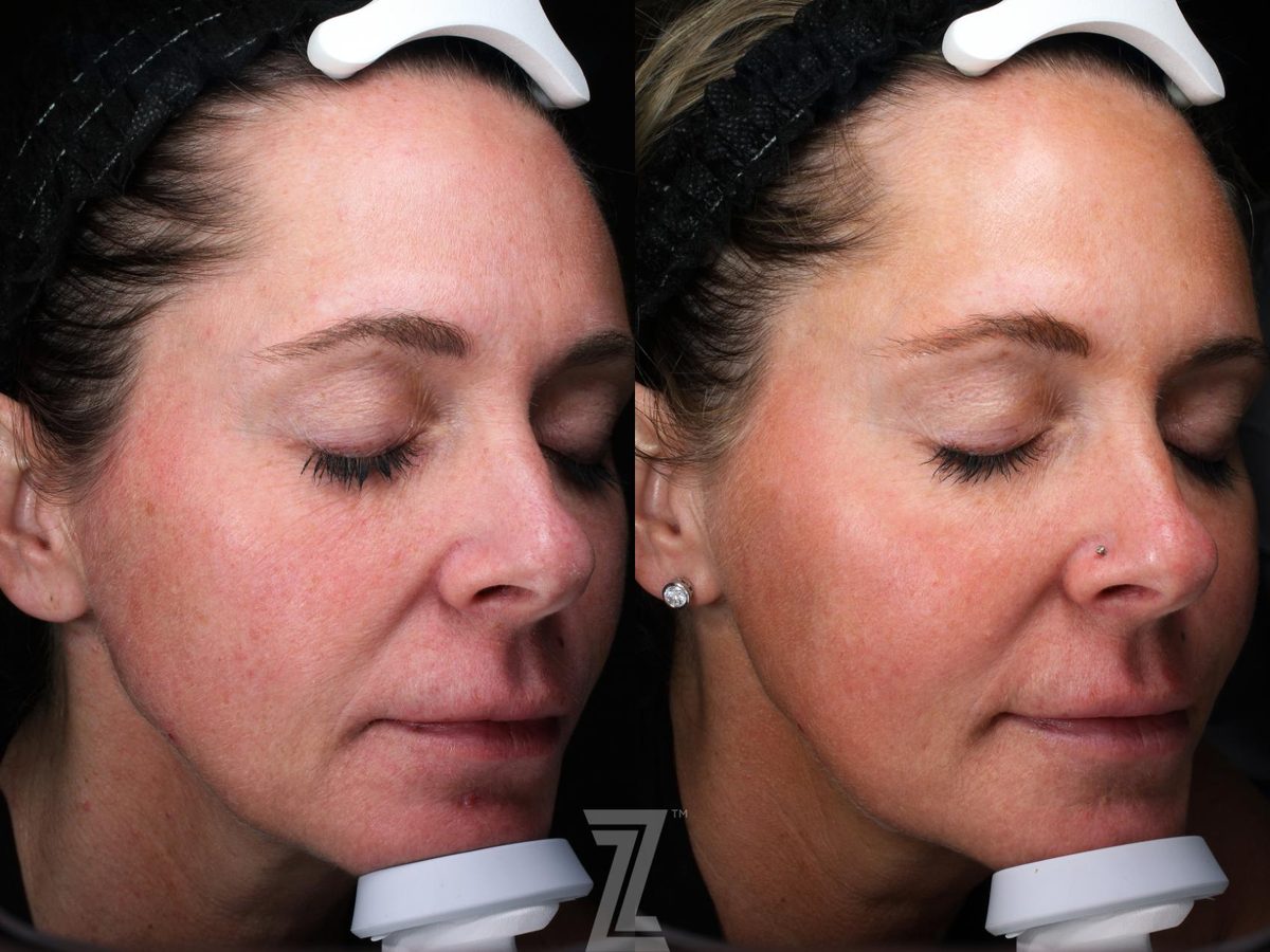 After: BBL, Visia Skincare Analysis — Case 548, The Piazza Center Austin