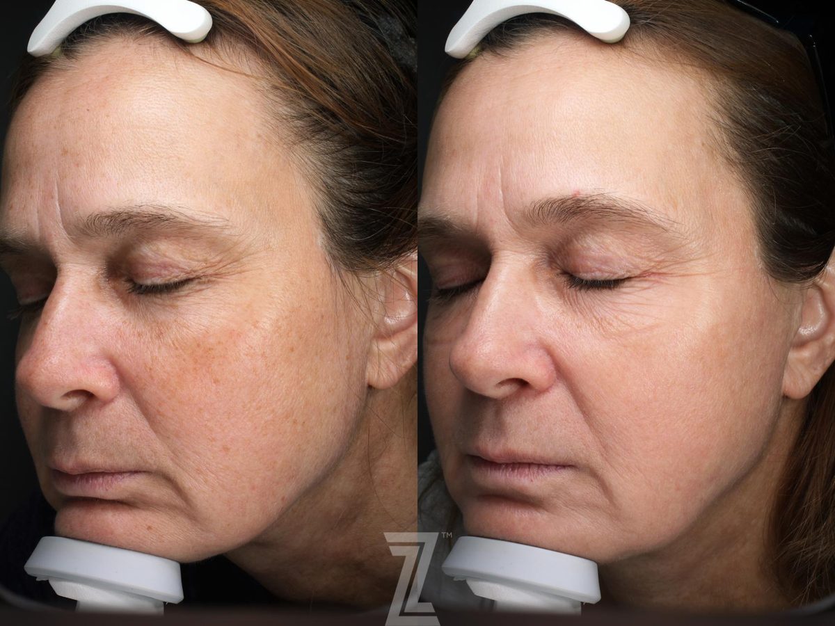 Before: Hyperpigmentation, Aging Skin, Wrinkles, Sun Damage, Visia Skincare Analysis — Case 570, The Piazza Center Austin