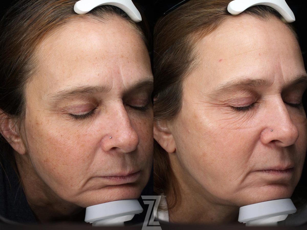 After: Hyperpigmentation, Aging Skin, Wrinkles, Sun Damage, Visia Skincare Analysis — Case 570, The Piazza Center Austin