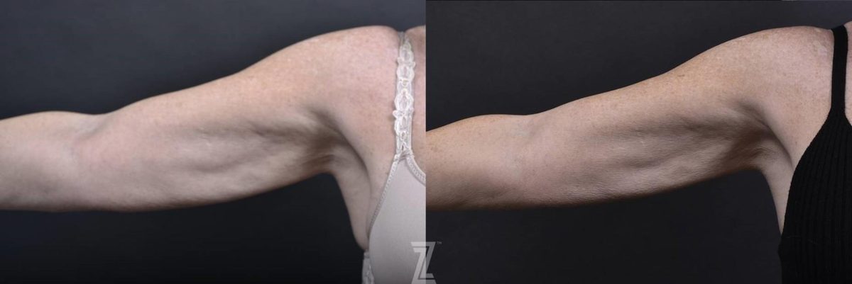 Before: Profound® RF Microneedling — Case 472, The Piazza Center Austin