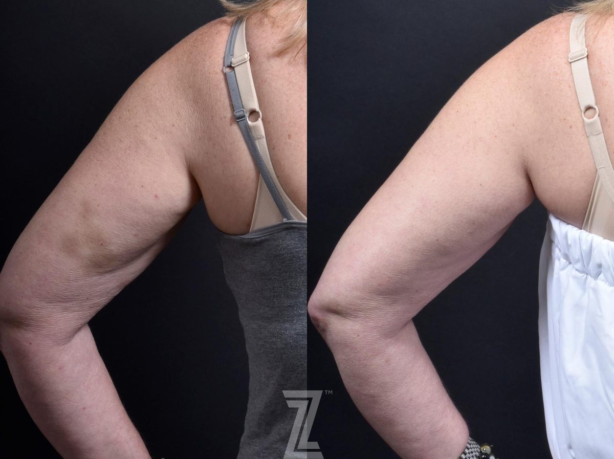 Before: Profound® RF Microneedling — Case 490, The Piazza Center Austin