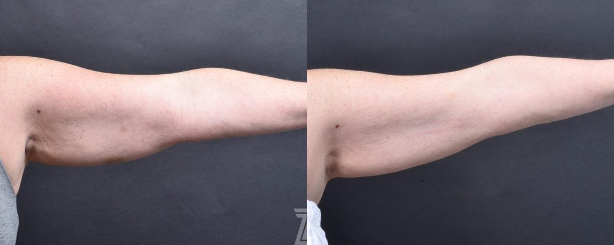 After: Profound® RF Microneedling — Case 490, The Piazza Center Austin