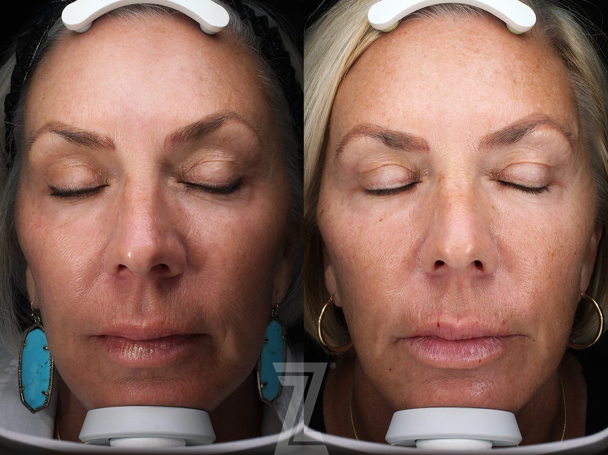 Before: Profound® RF Microneedling — Case 0003, The Piazza Center Austin