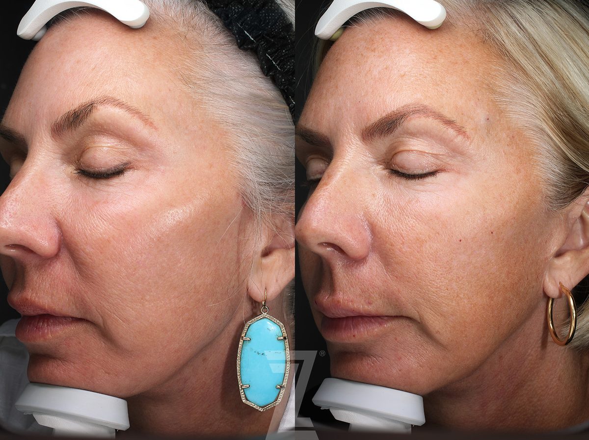 After: Profound® RF Microneedling — Case 0003, The Piazza Center Austin