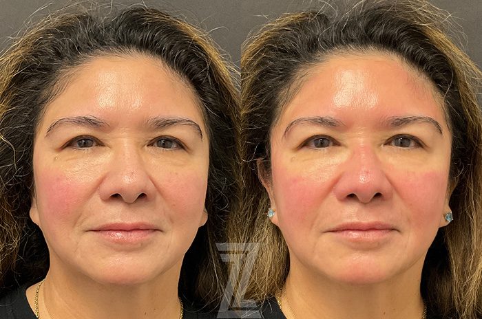 Before: HydraFacial™ — Case 2395, The Piazza Center Austin