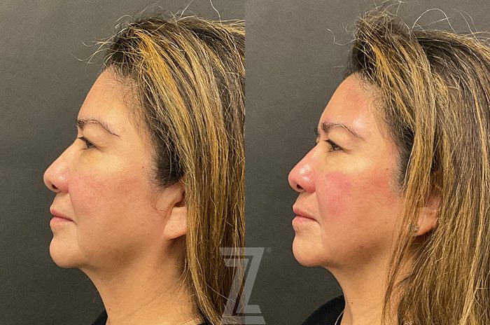 After: HydraFacial™ — Case 2395, The Piazza Center Austin