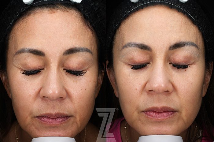 Before: Profound® RF Microneedling — Case 11897, The Piazza Center Austin
